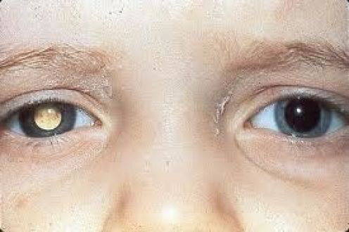 Синдром Кошачьего Глаза Фото