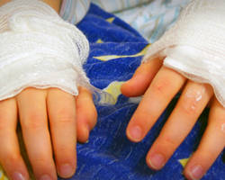 Неотложная помощь детям при термических травмах: ожогах и обморожениях