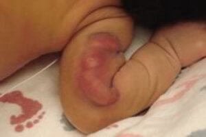 Некроз подкожножировой ткани у новорожденных