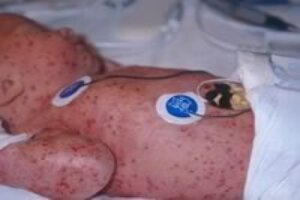 Лангергансоклеточный гистиоцитоз у новорожденных