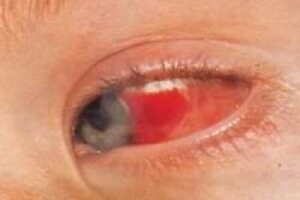 Кровоизлияния под конъюнктиву глаза у ребенка