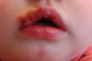 Герпетическая инфекция (простой герпес) у детей